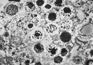 F,72y. | melanoblastoma oculi F,72y. | melanoblastoma oculi